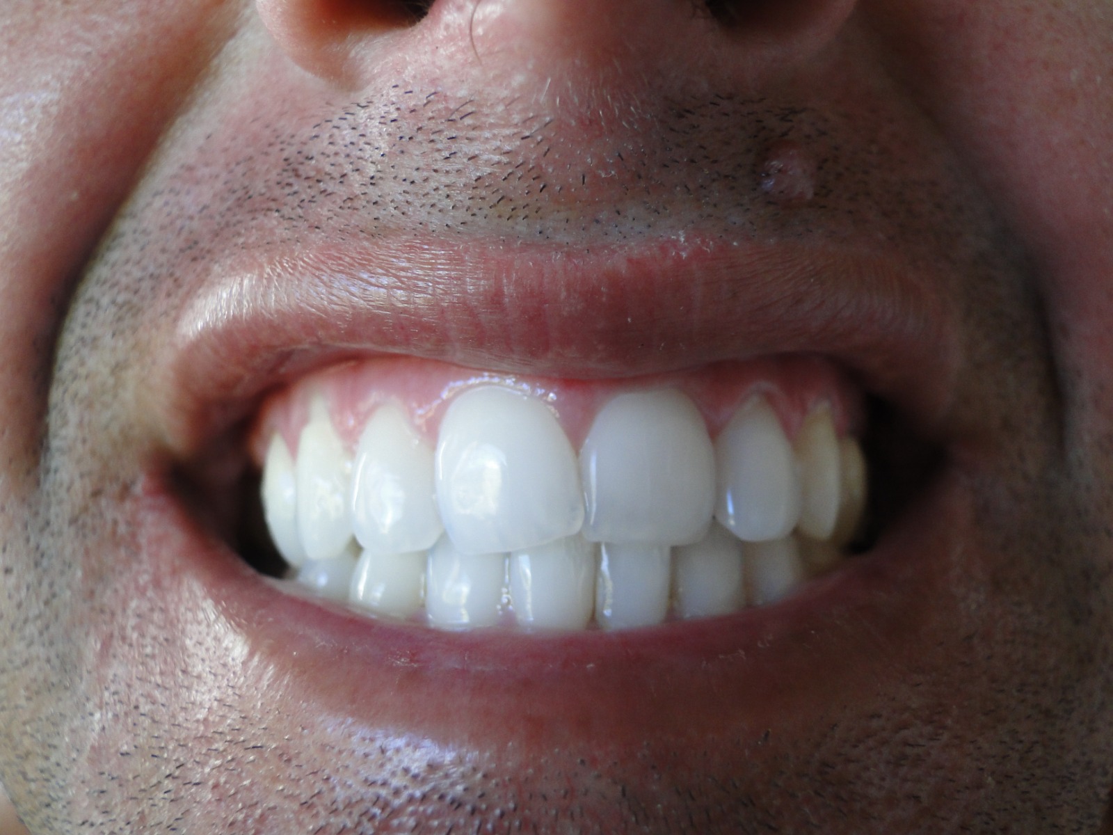 Depois do tratamento